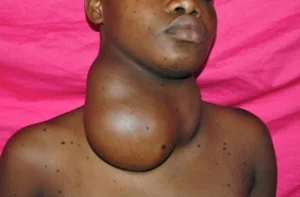 Ibyo benshi batazi ku ndwara y’umwingo